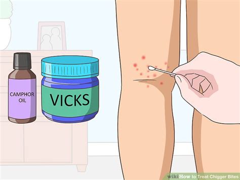 A vacuum works well to pick up chiggers on hard surfaces. Best thing for chigger bites - MISHKANET.COM