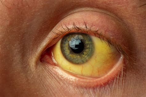 Aug 09, 2019 · gelbsucht (ikterus) ist keine krankheit, sondern ein symptom. 9 Ways Chronic Hepatitis C Can Affect Your Body