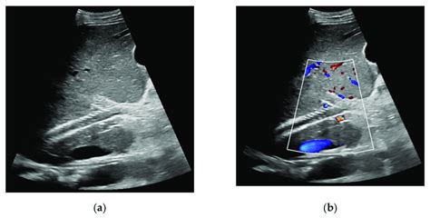 Transjugular Intrahepatic Portosystemic Shunt Ultrasound Evaluation