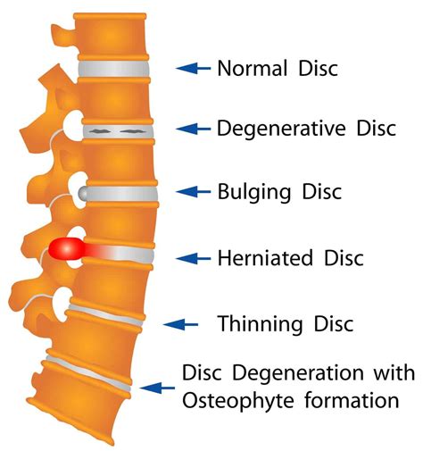 what are the causes and symptoms of a disc herniation advanced chiropractic spine and sports