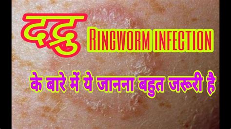 Ayurveda Treatment Of Ringworm Infection दद्रु Youtube