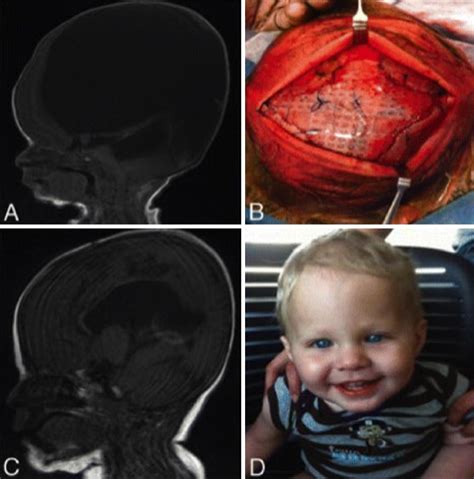 Early Postnatal Cranial Vault Reduction And Fixation Surgery For Severe