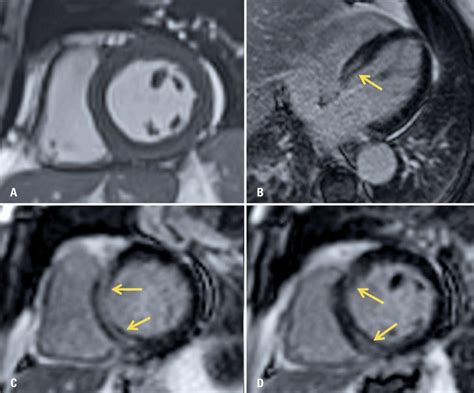 Miocarditis, miocarditis neom, miocarditis no especificada, miocarditis, sai, inflamación miocárdica (hallazgo), miocarditis, sai (trastorno). Miocardite na COVID-19: um relato de caso - einstein (São ...