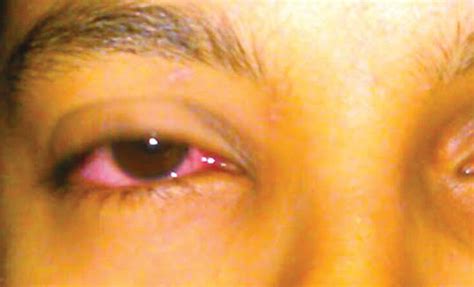 ‘madras Eye Cases Spawn Infections
