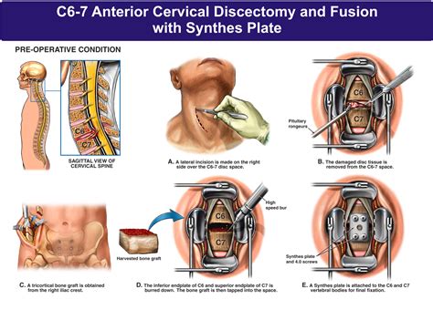 C Anterior Cervical Discectomy And Fusion With Synthes Plate Nbg