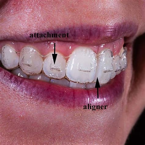 What Is Invisalign⁣ Soho Dental Toronto Dentist