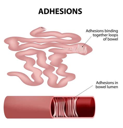 Treat Abdominal Adhesions With Myofascial Release A Holistic Approach