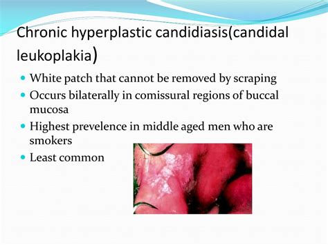 Ppt Candidiasis Powerpoint Presentation Free Download Id265068