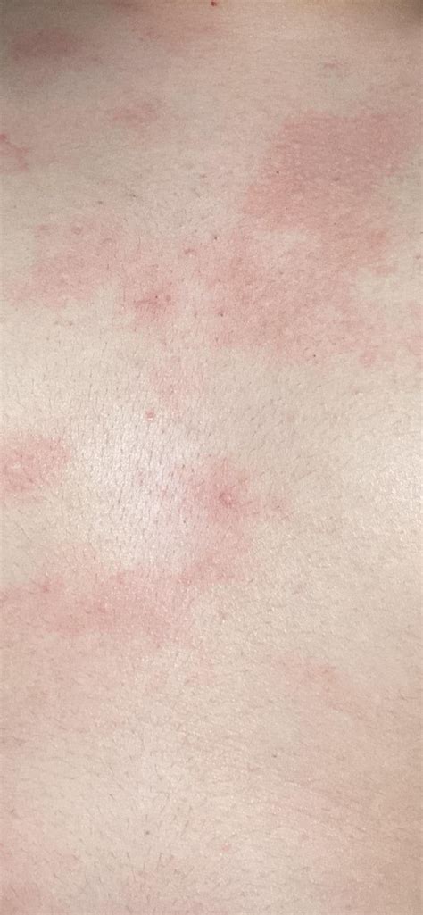 Eczema Hives Both Dermatologyquestions