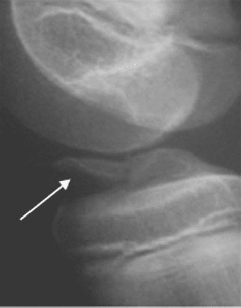 Arthroscopic Fixation Of Displaced Tibial Eminence Fractures A New