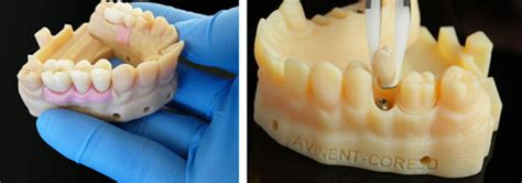 Impresión 3d En El ámbito De La Implantología Dental Metalmecánica