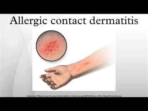 How many types of dermatitis are there? Allergic contact dermatitis - YouTube