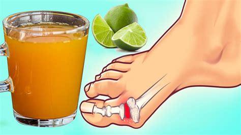 How To Get Rid Of Gout Pain Fast Gout Treatment At Home Naturally