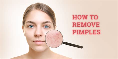 Tips On How To Remove Pimples And Its Marks Naturally And Permanently