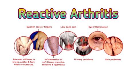 Reactive Arthritis A Review On Reactive Arthritis By Muhammad Hammad