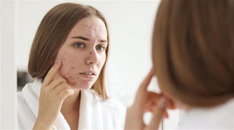 Does Acne Get Worse Before It Gets Better How To Know
