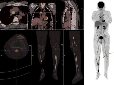 Total Body Petcomputed Tomography Highlights In Clinical Practice