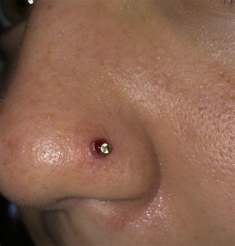 I Tried To Pop An Irritated Nose Piercing Bump And Now It Looks Like This I Have No Idea How To