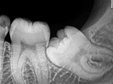 Wisdom Teeth Pain Wisdom Tooth Symptoms Impacted Molars And Extraction