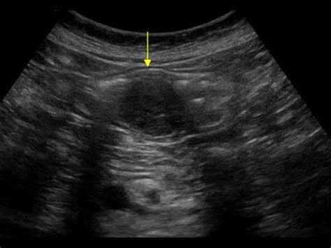 Abdomen And Retroperitoneum 18 Various Intra Abdominal Tumors Case