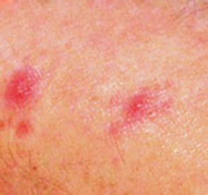 Thankfully, most spiders bite only when provoked. Mosquito Bites On Legs Red