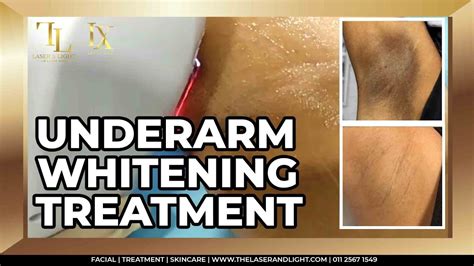 Dark Underarm Whitening Treatment⚡️ The Laser And Light Medical Youtube