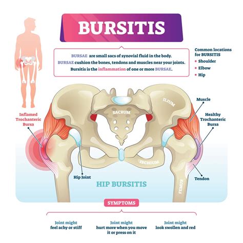 Hip Bursitis Exercises Bursitis Hip Trochanteric Bursitis The Best