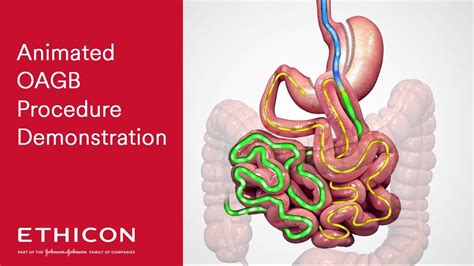 One Anastomosis Gastric Bypass Oagb Animated Patient Education Video Ethicon Youtube