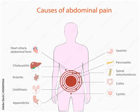 Causes Of Abdominal Pain Vector Medical Diagram Stock Vector Adobe