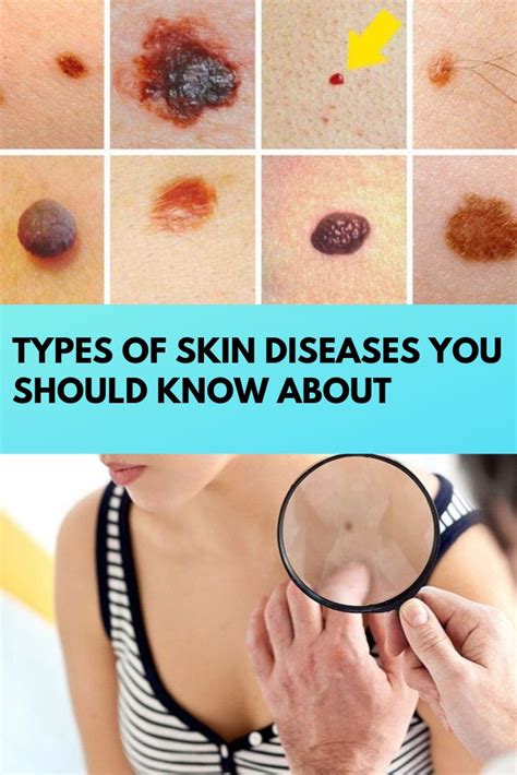 Types Of Skin Diseases You Should Know About Skin Diseases Health Disease