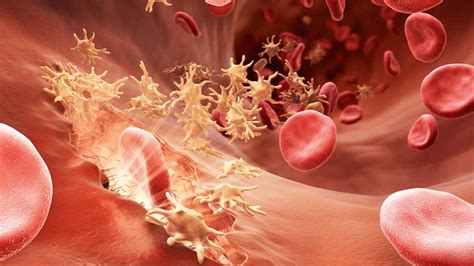 Gene therapy could be 'ideal cure' for hemophilia B | Genetic Literacy