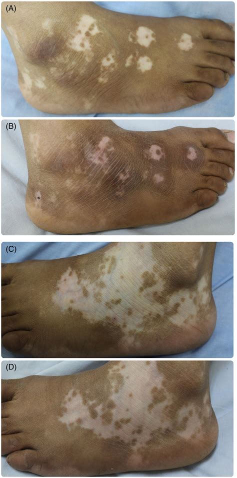 Female Patient 30 Years Old With Vitiligo Patch At The Dorsal Surface