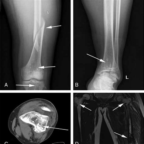 A Plain Radiograph Spiral Fracture In Left Femoral Shaft And