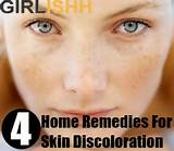 Perfect Skin Home Remedies