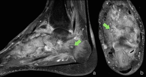 Mycetoma or madura foot is a chronic granulomatous infection of the dermis and epidermis caused by source: Madura foot: an approach to imaging-based diagnosis | Eurorad