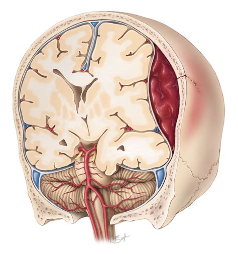 Epidural Hematoma The Neurosurgical Atlas