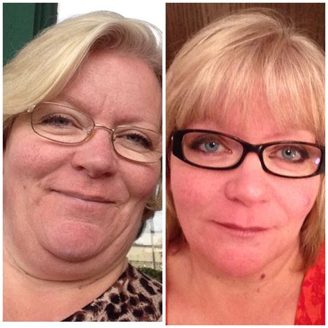 Hypothyroid In Photos Before And After Stop The Thyroid Madness