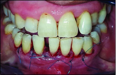 Gingivectomy Gingivoplasty Internal Bevel Incision And Sutures