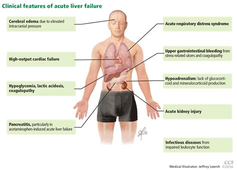 A Guide To Managing Acute Liver Failure Cleveland Clinic Journal Of