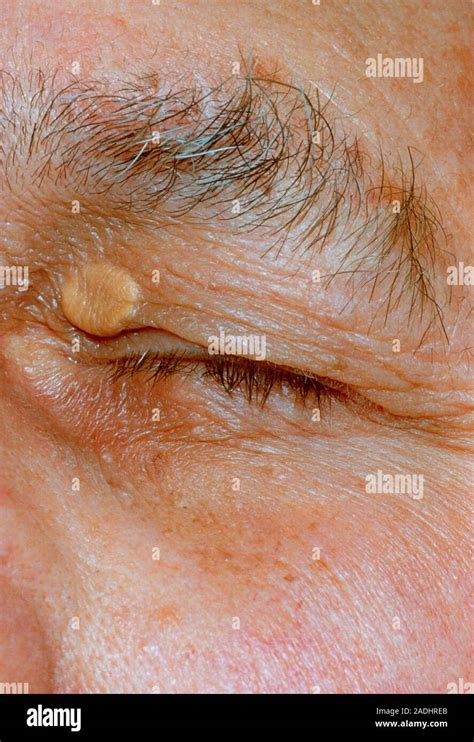 Xanthelasma A Yellow Disc Like Swelling In The Skin Of The Upper