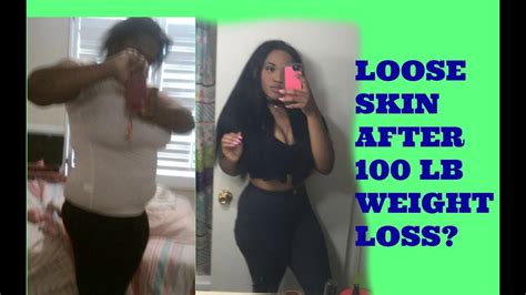 We did not find results for: MY LOOSE SKIN AFTER LOSING 100 POUNDS! - YouTube