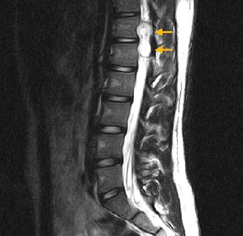 Spinal Schwannoma In A Young Adult Journal Of Orthopaedic And Sports