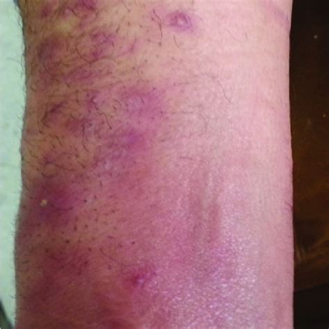 Papular And Erythematous Rash With Pustules On The Inside Of The