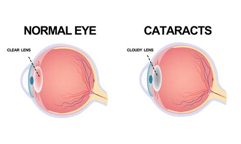 Cataract Surgery In Atlanta Ga Atlanta Cateract Surgeon Lotus Version