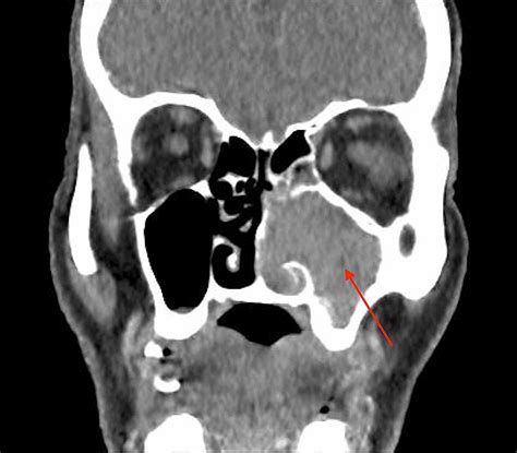 Cureus Inverted Sinonasal Papilloma Involving The Middle Ear With