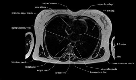 Chest Anatomy Mri Chest Thorax Axial Anatomy Free Cross Sectional The