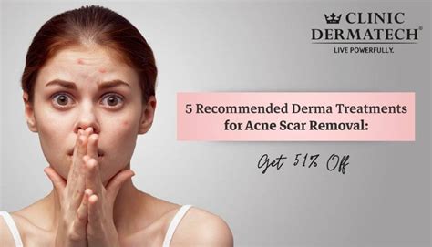 5 Recommended Derma Treatments For Acne Scar Removal Get 51 Off