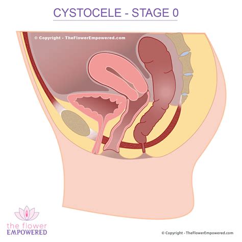 Cystocele Prolapsed Bladder Pelvic Organ Prolapse Stage 0 To 4