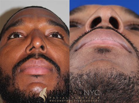 Male Ethnic Rhinoplasty Before And After Facial Plastic Surgeon
