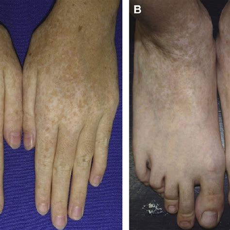 Comparison Of Patients With Dyschromatosis Symmetrica Hereditaria In
